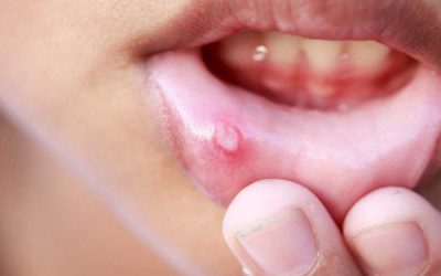 Obat Sariawan Yang Ampuh