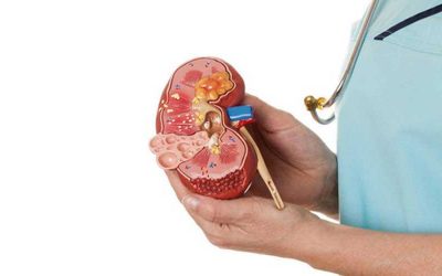 Cara Menjaga Ginjal Agar Tetap Sehat Selalu